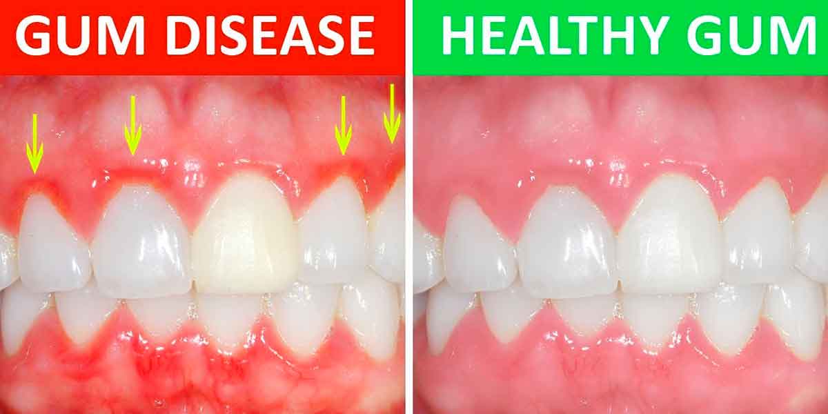 Periodontal Disease – You Might Have it and Not Even Know It